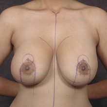 Breast Lift with Implants before and after, case 01 (before)