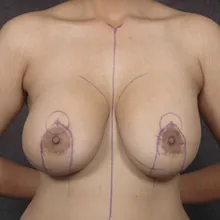 Breast Lift with Implants, case 01, before