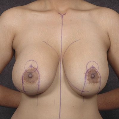Breast Lift with Implants before, case 01
