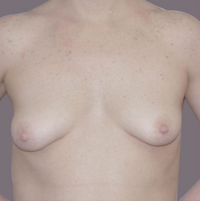 Breast Lift with Implants before and after, case 09, view 5 (before)