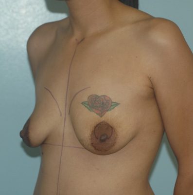Breast Lift (Mastopexy) before, case 02
