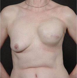 Breast Reconstruction before and after, case 01, view 1 (progress)