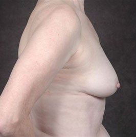 Breast Reconstruction before and after, case 01, view 4 (before)