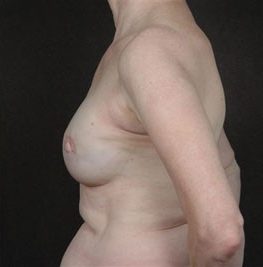 Breast Reconstruction before and after, case 01, view 5 (after)