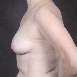 Breast Reconstruction before and after, case 01, view 5 (before)