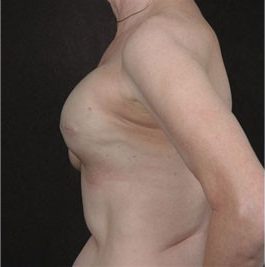 Breast Reconstruction before and after, case 01, view 5 (progress)