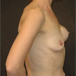 Breast Reconstruction before and after, case 02, view 4 (progress)
