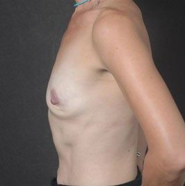 Breast Reconstruction before and after, case 02, view 5 (before)