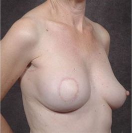 Breast Reconstruction before and after, case 03, view 2 (progress)