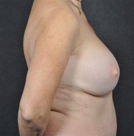 Breast Reconstruction before and after, case 03, view 4 (after)