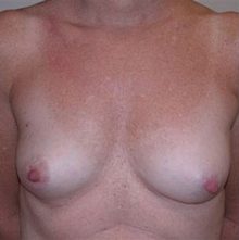 Breast Reconstruction before and after, case 05 (before)