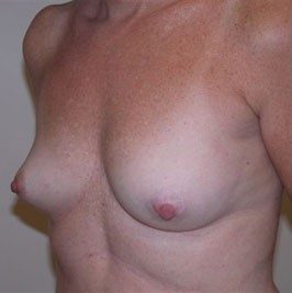 Breast Reconstruction before and after, case 05, view 3 (before)