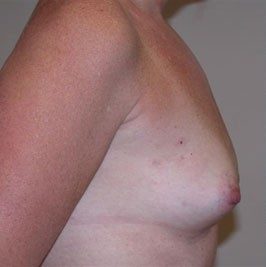 Breast Reconstruction before and after, case 05, view 4 (before)