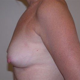 Breast Reconstruction before and after, case 05, view 5 (before)