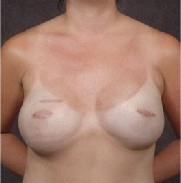 Breast Reconstruction before and after, case 06, view 1 (progress)