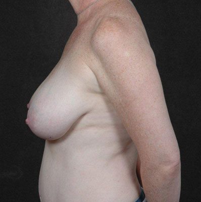 Breast Reduction before and after, case 05, view 5 (before)