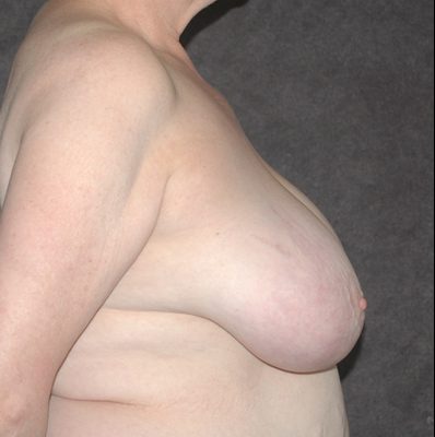 Breast Reduction before and after, case 09, view 3 (before)