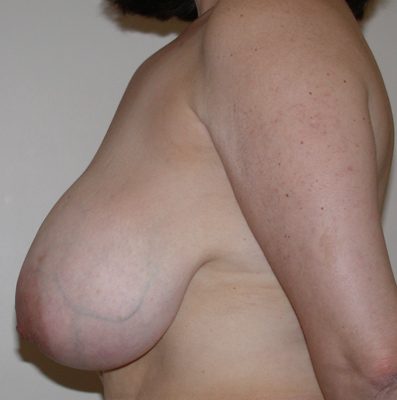 Breast Reduction before and after, case 10, view 5 (before)