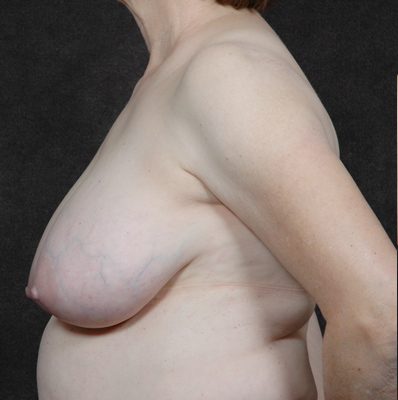 Breast Reduction before and after, case 12, view 4 (before)