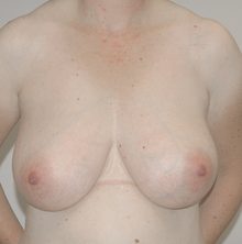 Breast Reduction before and after, case 17 (before)