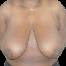 Breast Reduction before and after, case 20 (before)