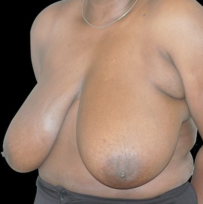 Breast Reduction before and after, case 20, view 4 (before)