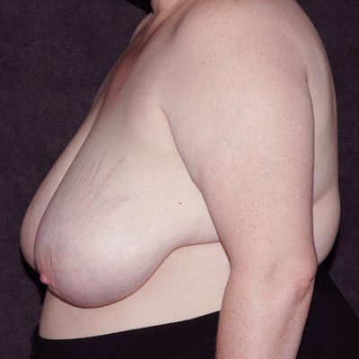 Breast Reduction before and after, case 22, view 3 (before)