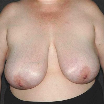 Breast Reduction before and after, case 22, view 4 (before)