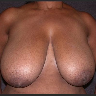 Breast Reduction before and after, case 25, view 5 (before)