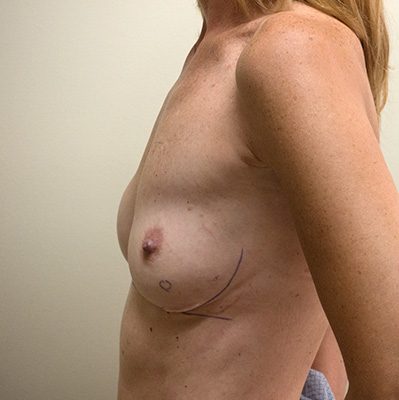 Implant Revision before and after, case 19, view 5 (before)