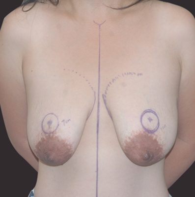 Internal Bra Mastopexy before, case 01