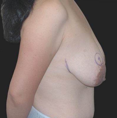 Internal Bra Mastopexy before and after, case 01, view 3 (before)