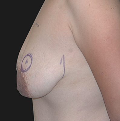 Internal Bra Mastopexy before and after, case 01, view 4 (before)