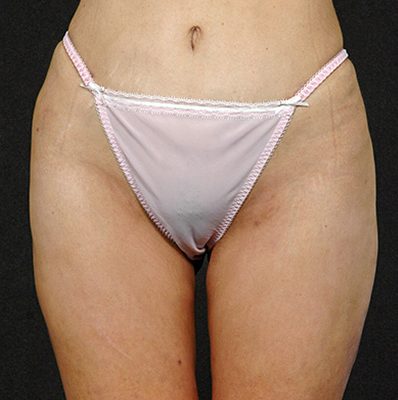 Liposuction after, case 01