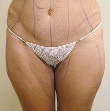 Liposuction before and after, case 01 (before)
