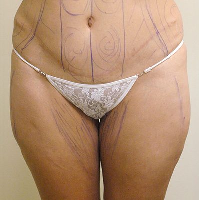 Liposuction before, case 01