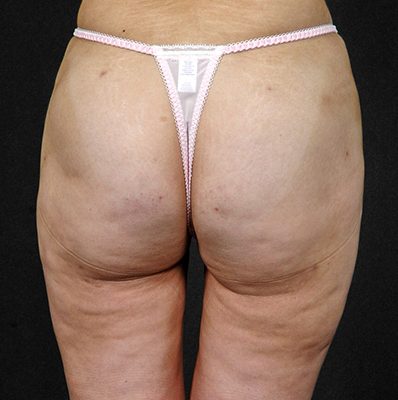 Liposuction before and after, case 01, view 3 (after)