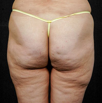 Liposuction before and after, case 01, view 3 (before)