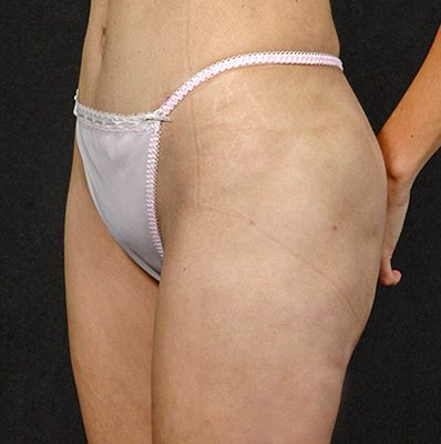 Liposuction before and after, case 01, view 4 (after)