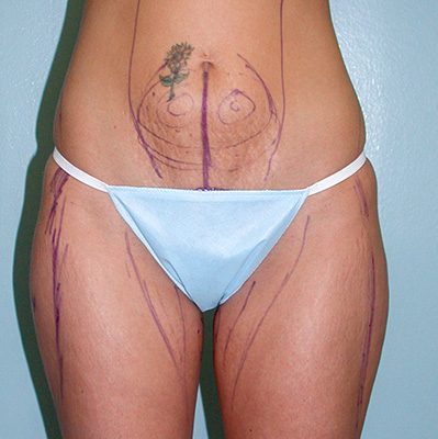 Liposuction before, case 02