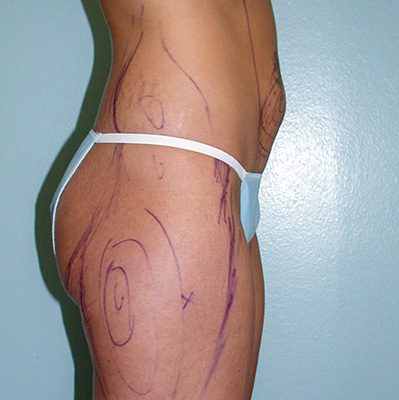 Liposuction before and after, case 02, view 3 (before)