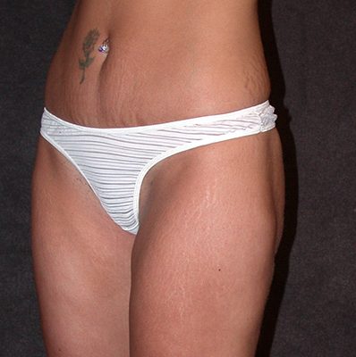 Liposuction before and after, case 02, view 4 (after)