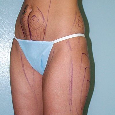 Liposuction before and after, case 02, view 4 (before)