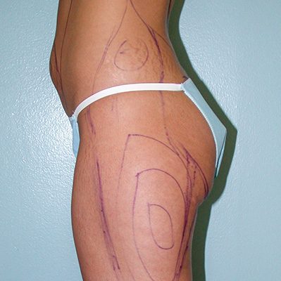 Liposuction before and after, case 02, view 5 (before)