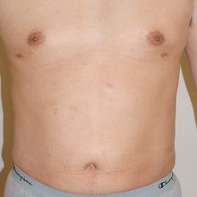 Liposuction before and after, case 03 (after)