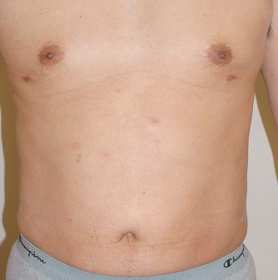 Liposuction after, case 03