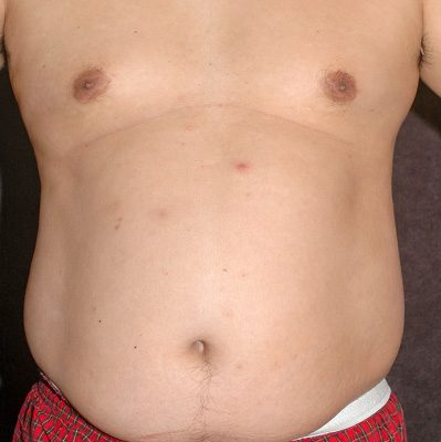 Liposuction before, case 03