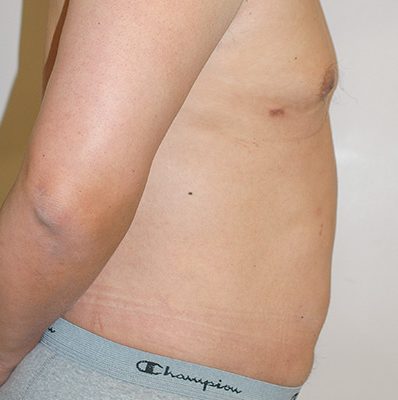 Liposuction before and after, case 03, view 3 (after)