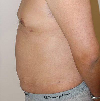 Liposuction before and after, case 03, view 4 (after)