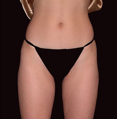 Liposuction after, case 04